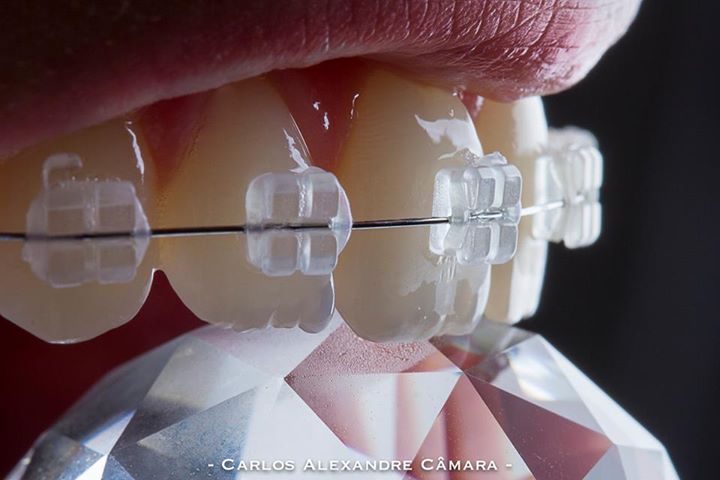 Tipos-de-aparelhos-dentes-e-suas-funçoes-NKS-odontologia